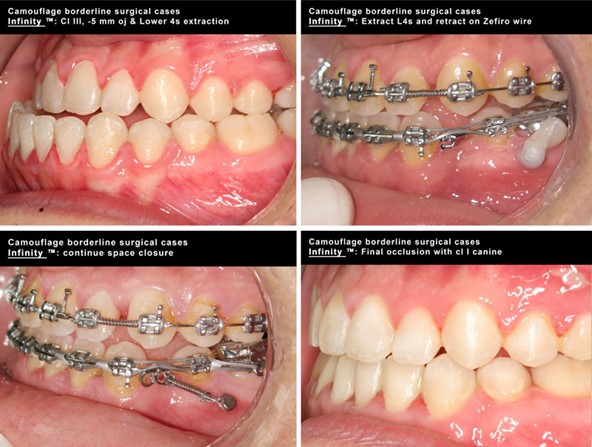 underbite correction with mini implant temporary anchorage device Tads